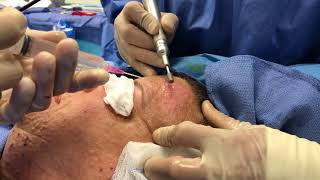 Surgeon Explains Dermabrasion for Cutaneous Neurofibromas [upl. by Aiseneg]