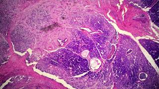 Mucoepidermoid Carcinoma High Grade [upl. by Lrak56]