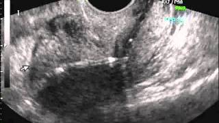 ✅ Ultrasound for Mirena Contraception [upl. by Hoeve]