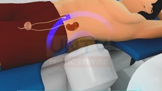 Kidney Stones Actual ESWL procedure [upl. by Paterson6]