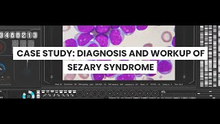 Diagnostic Evaluation of Sezary Syndrome A Case Study of workup and diagnosis of Tcell leukemia [upl. by Zashin]