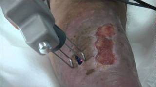 Phlebology  Debridement and Photobiostimulation of Venous Ulcer  Ulcera LASEmaR [upl. by Selohcin]