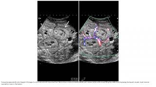 Mesenchymal Hamartoma Imaging [upl. by Adao]