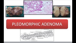 Pleomorphic Adenoma [upl. by Corotto]