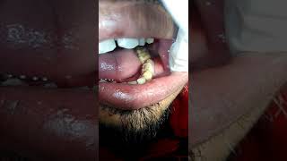 Buccal space infection Dr Prabhuraj Sabarad MDS [upl. by Nyrrad]