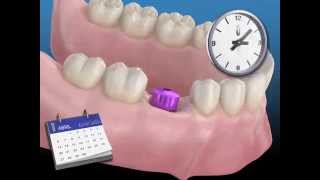 Todo sobre los implantes dentales [upl. by Cayser379]