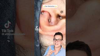 BLACKHEADS IN EAR  Blackhead Removal From Ear shorts [upl. by Zurheide]