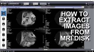 HOW TO EXTRACT IMAGES FROM A MRI DICOM DISK [upl. by Verner]