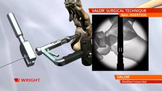 VALOR™ Hindfoot Fusion Nail System Animation [upl. by Ynad]