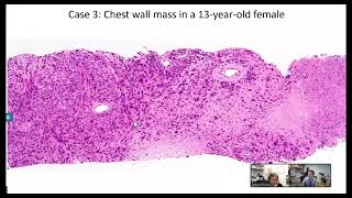 In this video David Papke PapkeDavid and I discuss four emerging mesenchymal tumors [upl. by Claudian71]