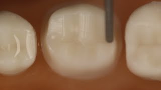 PFM Crown Posterior Tooth Preparation With Metal Occlusal [upl. by Nonnad273]