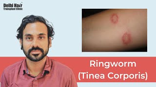 Ringworm Tinea Corporis  Causes Risk Factors Signs amp Symptoms Diagnosis and Treatment  DHTC [upl. by Edmonds]