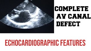 atrioventricular canal septaldefectintermediate form [upl. by Punke628]