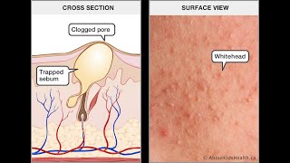 How to Control Sebum oil production in skin Azeemtech [upl. by Denny]