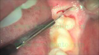 Dr Roberto Barone Dr Carlo Clauser Dr Angelo Baleani  Wisdom tooth surgical flap incision [upl. by Lyrak356]