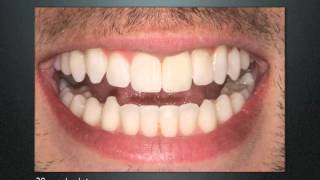 Inman Aligner Video [upl. by Anali49]