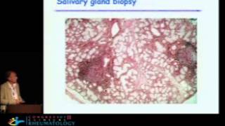 Update on Sjogrens syndrome from pathogeny to treatment  Xavier Mariette MD PhD [upl. by Aileon]