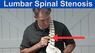 What is Lumbar Spinal Stenosis [upl. by Aital607]