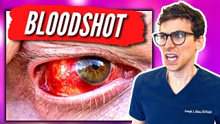 Bloodshot Eyes  What Causes Bloodshot Eyes and How to Get Rid of Them  Doctor Eye Health [upl. by Akehsyt]