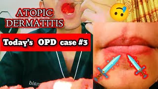 Atopic Dermatitis ❤️General OPD CASE 3 ❤️ skincare skincareroutine treatment girl eczema [upl. by Kristo764]