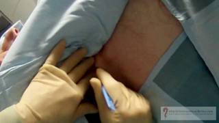 subcutaneous venous port insertion [upl. by Eimar]