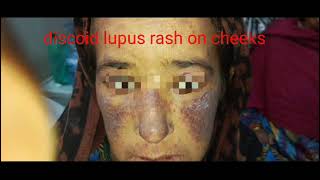 quotDISCOID LUPUS RASH ON CHEEKSquot [upl. by Linc344]