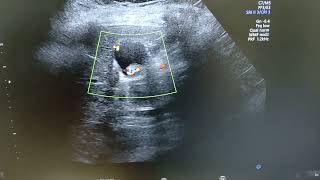 Adenomyomatosis  Comet tail artifacts  Choleithiasis [upl. by Vaientina]