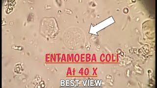 Entamoeba Coli best view in stool microscopy at 40XEColi in stool microscopyParasites in stool [upl. by Glendon624]