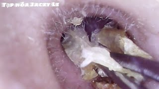 Ear Wax Removal 16  Ear Cleaning ASMR  Video Relaxing [upl. by Oznecniv]