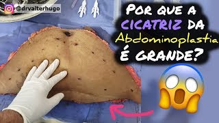 ABDOMINOPLASTIA Por que a Cicatriz é Grande  Dr Valter Hugo [upl. by Areem]