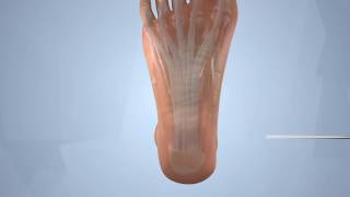 EPF  Endoscopic Plantar Fasciotomy [upl. by Euqinemod]