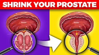 Enlarged Prostate Gland or Benign Prostatic Hyperplasia BPH [upl. by Pappano392]