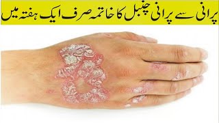 Chanbal ka ilajpsoriasis complete treatment in urdu by Hiqmat or Amliyat [upl. by Irrehs]