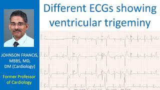 Different ECGs showing ventricular trigeminy [upl. by Cocke127]