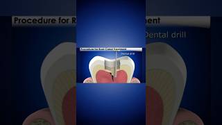 RCT Procedure  Procedure For Root Canal Treatment Part 1 shorts trending [upl. by Aurelio424]