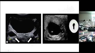 Posterior Urethral Valve [upl. by Ecirtahs277]