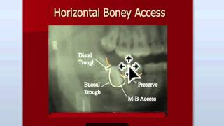 Oral Surgery Hints  Impactions Continued [upl. by Marchese]