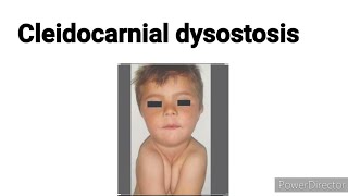 Cleidocranial dysostosis  Cleidocranial dysplasia  Basic concept building [upl. by Bourgeois]