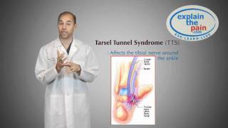 What is Tarsal Tunnel Syndrome [upl. by Sylvanus]