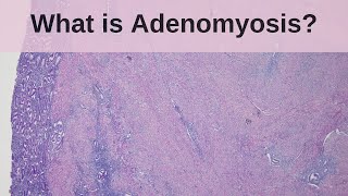 What is Adenomyosis  Pathology mini tutorial [upl. by Howund]