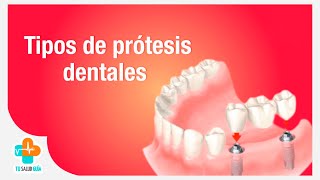 Tipos de prótesis dentales  Tu Salud Guía [upl. by Suiratnod182]