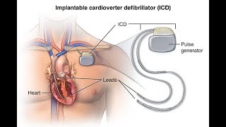 ICDS Implantable CardioverterDefibrillators PACE CARDIOLOGY [upl. by Aicnorev]