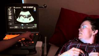 Nuchal Translucency Scan  First Trimester [upl. by Radferd]