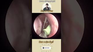 귀지형 콧물 부비동염 축농증 비염 코청소 이비인후과 rhinorrhea rhinitis sinusitis ASMR [upl. by Oiliruam]