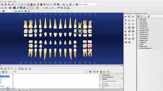 Hard Tissue Charting on Dentrix [upl. by Nnahtur]