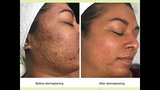 Dermaplaning Facial  VS MedSpa Laser Clinic [upl. by Aisatsan]