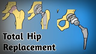 Total Hip ReplacementSurgery Se Pehle Janiye Sab Kuch in hindi amp english hippain hipreplacement [upl. by Lleder]