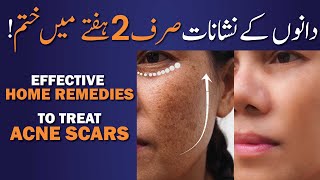 2 Best Face Pack for Acne Scars Treatment Naturally  Home Remedies for Acne Scars [upl. by Eidnil]