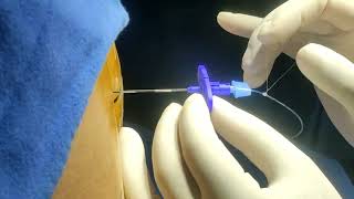 Lumber Epidural Catheterization For Anaesthesia amp Pain Management [upl. by Nedda448]