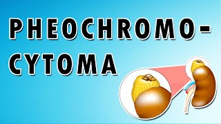 Pheochromocytoma Symptoms Treatment and Causes [upl. by Evette]